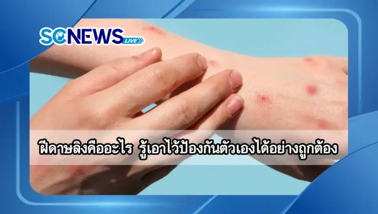 Read more about the article ฝีดาษลิง คืออะไร? รู้เอาไว้ ป้องกันตัวเองได้อย่างถูกต้อง